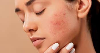 Quels sont les remèdes efficaces contre l'acné ?
